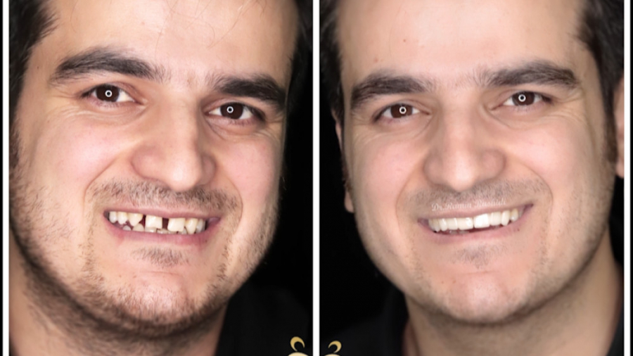 روکش زیرکونیا کلینیک دندانپزشکی موذن