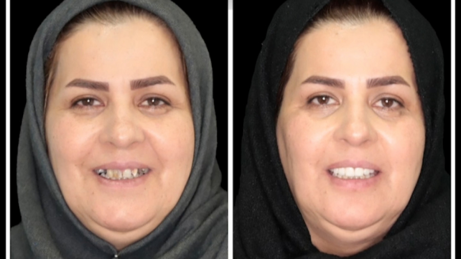 اصلاح خط لبخند با روکش زیرکونیا کلینیک دندانپزشکی موذن