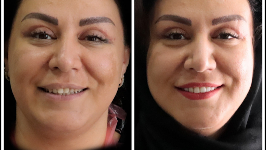 تعویض کامپوزیت ونیر غیر اصولی کلینیک دندانپزشکی موذن