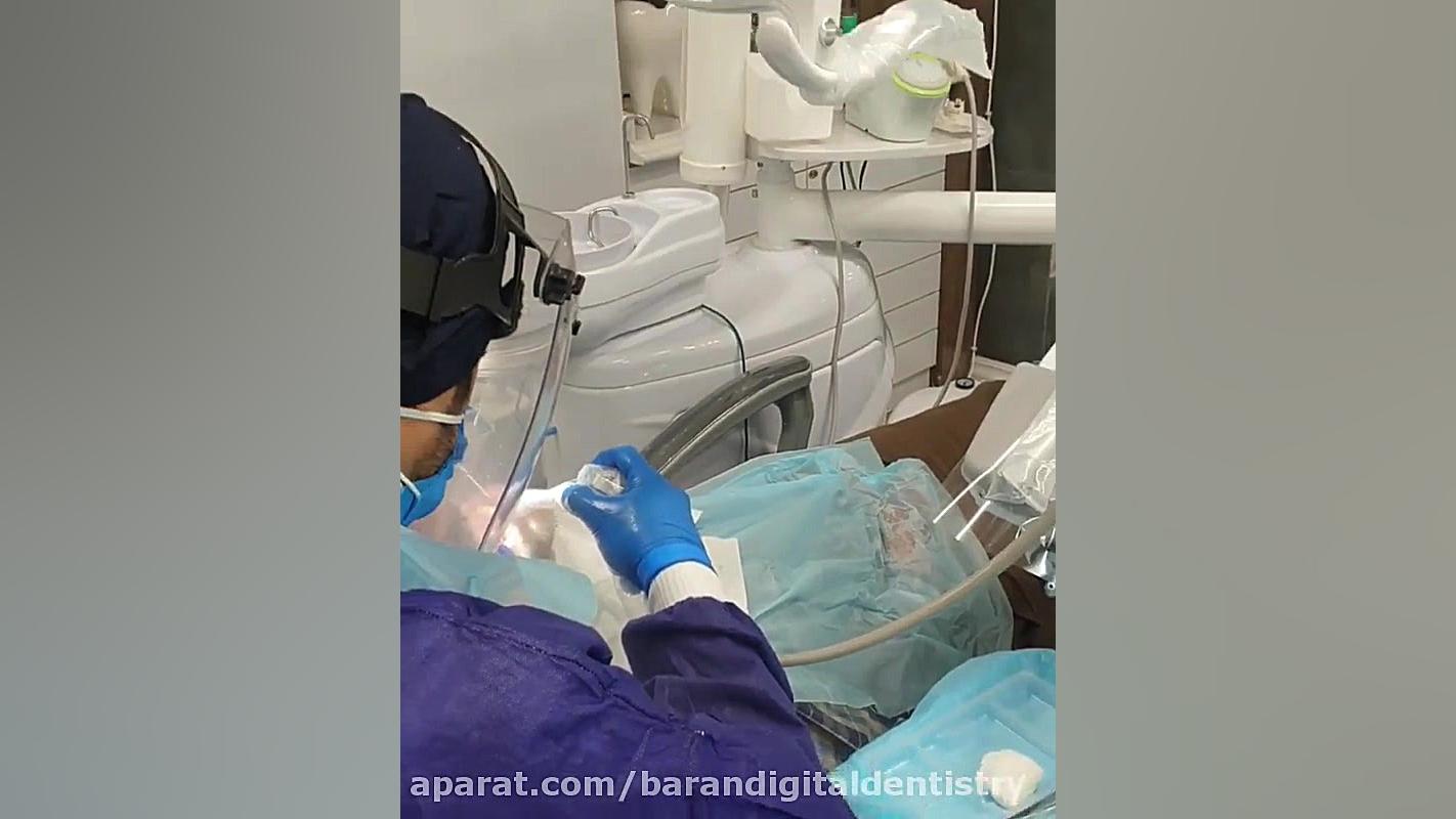 جرمگیری دندان به روش ایرفلو در دندانپزشکی دیجیتالی باران لیفت صورت
