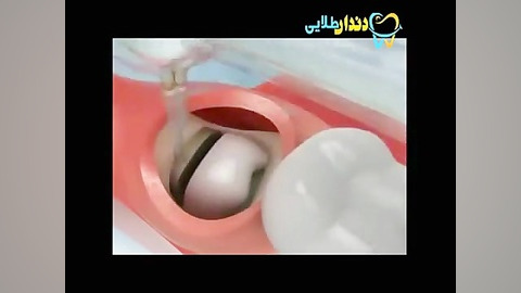 كشیدن دندان عقل نهفته pO2