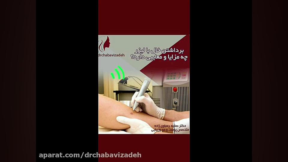 فیلم برداشتن خال با لیزر و مزایای آن دکتر صفیه چعباوی زاده