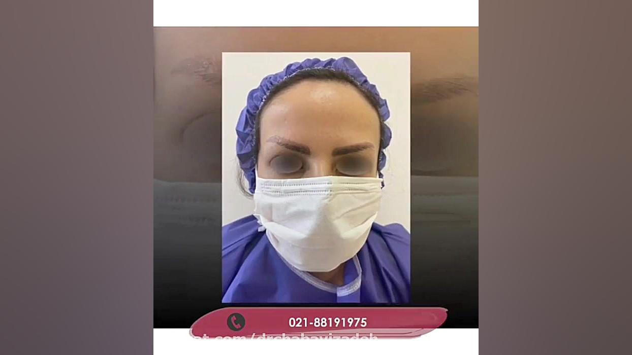 فیلم نمونه واقعی کاشت ابروی طبیعی دکتر صفیه چعباوی زاده