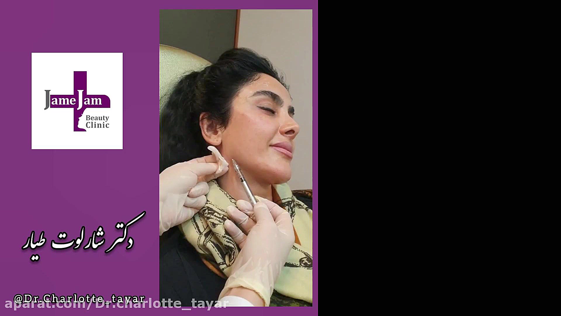 تزریق ژل و زاویه‌سازی صورت، دکتر شارلوت طیار کلینیک زیبایی