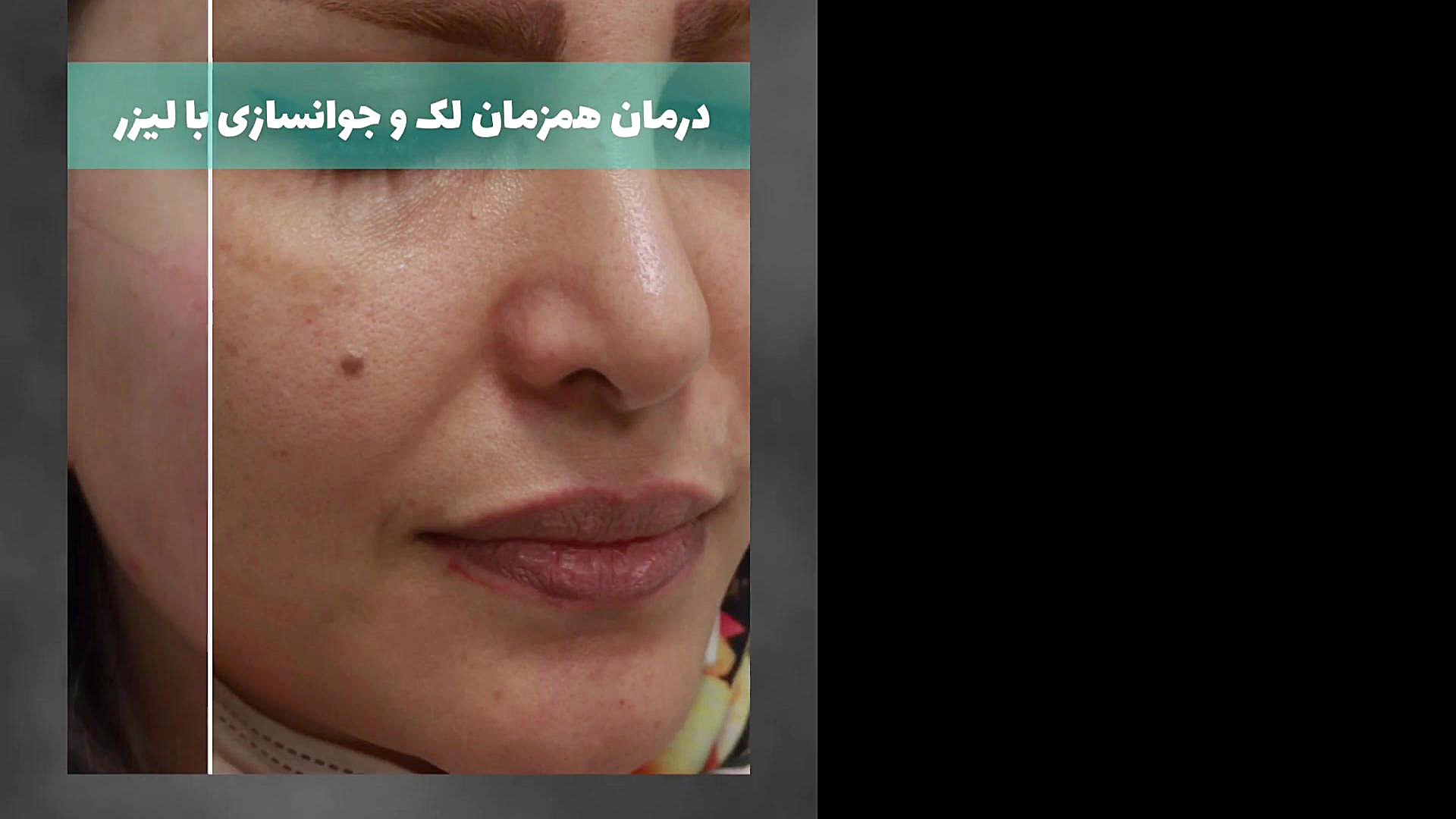 درمان همزمان لک صورت و جوانسازی با لیزر لیزر صورت
