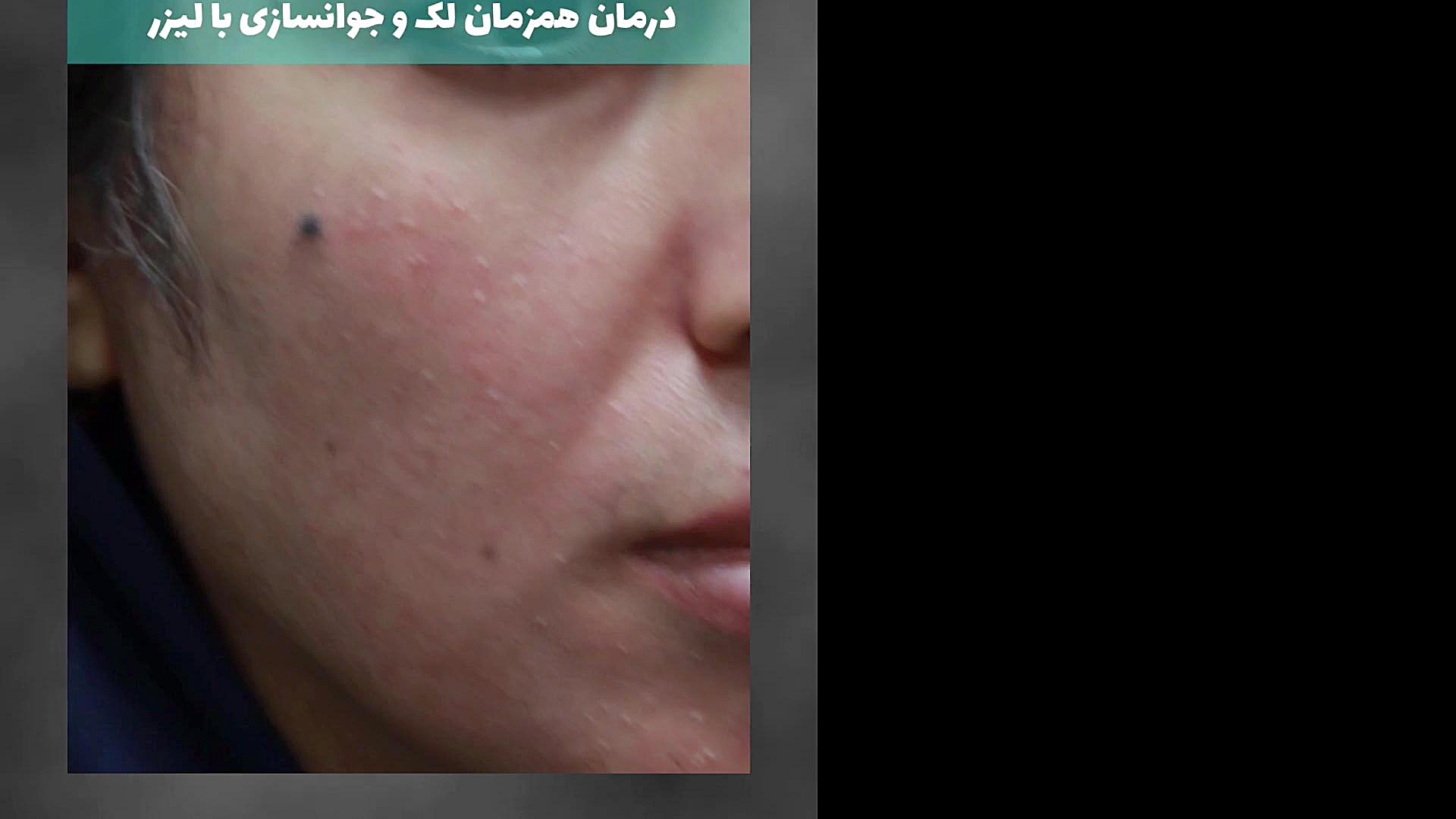 درمان همزمان لک صورت و جوانسازی با لیزر کلینیک دندانپزشکی