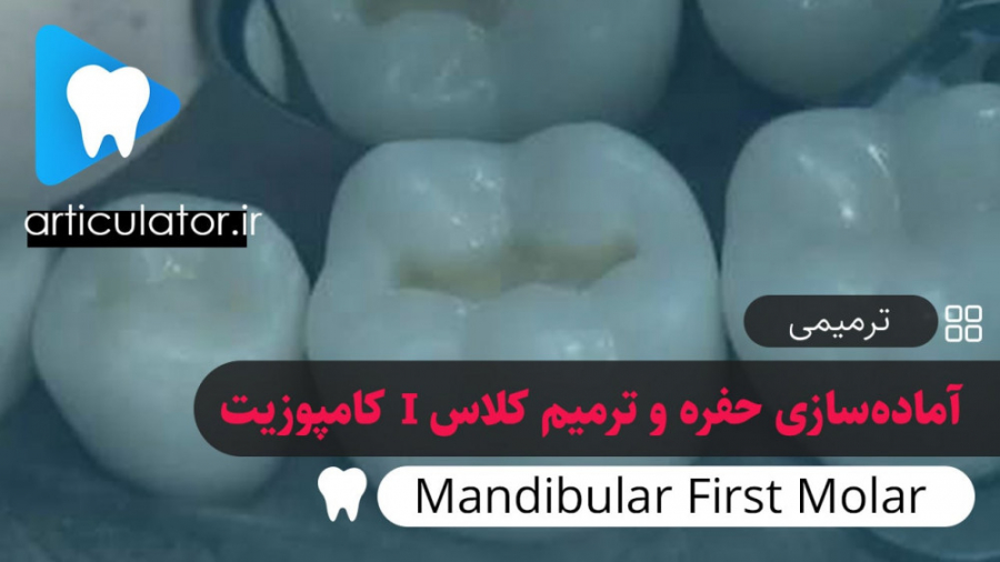آماده سازی حفره و ترمیم کلاس یک کامپوزیت دندان مولر اول مندیبل عمل زیبایی