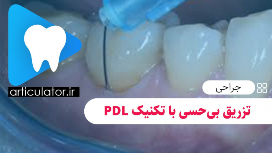 تزریق بیحسی با تکنیک PDL اندودنتیکس