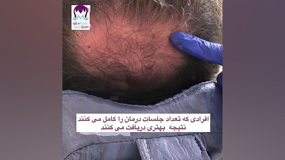 رضایت از انجام مزوتراپی مو-موگه کلینیک پزشکی ویرایش ژن