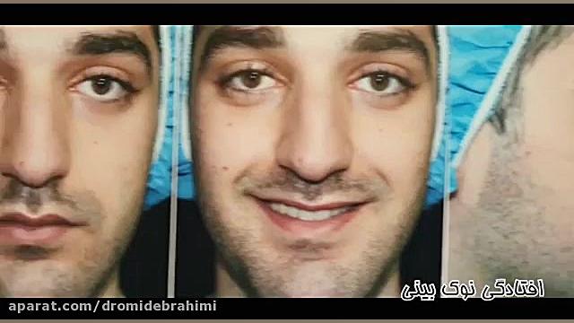 عمل بینی گوشتی قوزدار توسط دکتر امید ابراهیمی بهترین جراح بینی طبیعی کار دکتر امید ابراهیمی