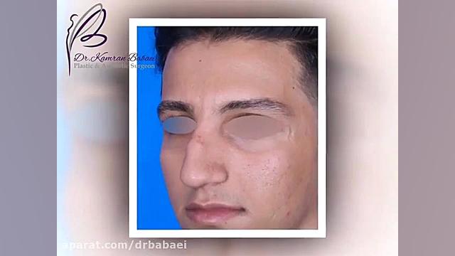 فیلم واقعی عمل بینی شکسته و کج دکتر کامران بابایی