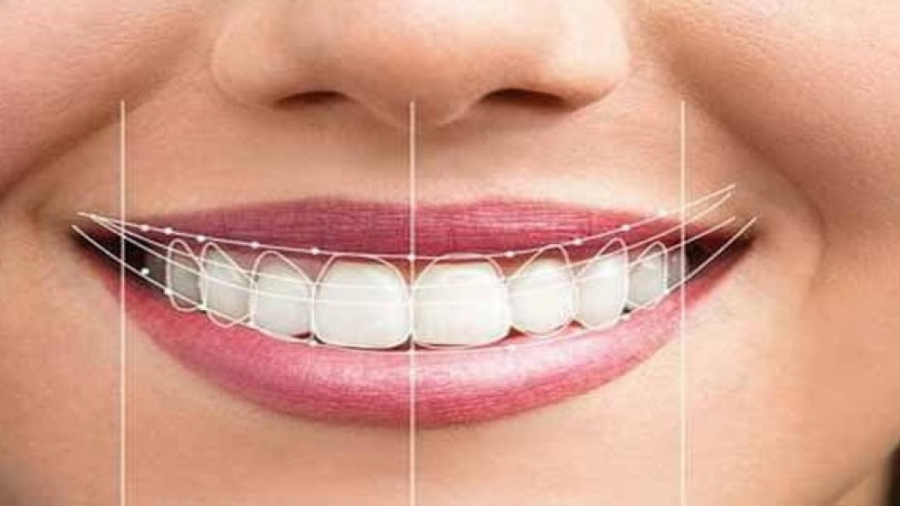 اصلاح طرح لبخند دکتر ندا هادی-دندانپزشک زیبایی