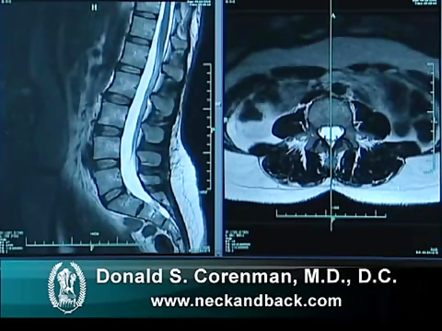 Диск для мрт. Мрт пояснично-крестцового перехода. Мрт прямой спины. Мрт шейно сакральных сочленений. Растяжение спины снимок мрт.