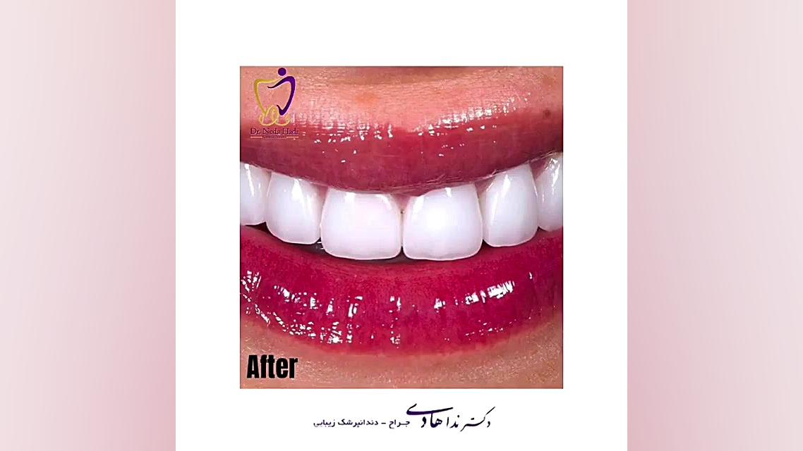 لبخند مراجعه کننده دکتر ندا هادی-دندانپزشک زیبایی
