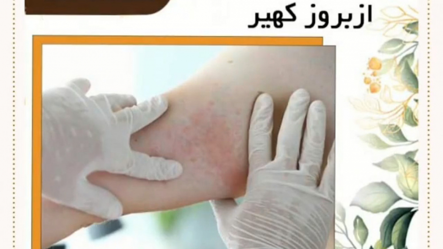 فیلم پیشگیری از بروز کهیر دکتر یعقوب محبوبی اسکوئی