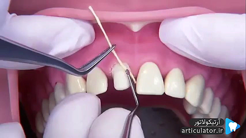 نحوه نخ گذاری در پروتز ثابت قلی قندق
