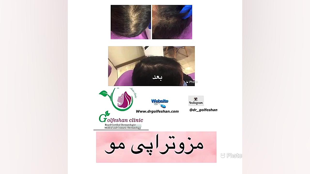 مزوتراپی مو دکتر عاطفه گلفشان، متخصص پوست مو و لیزر درمانی