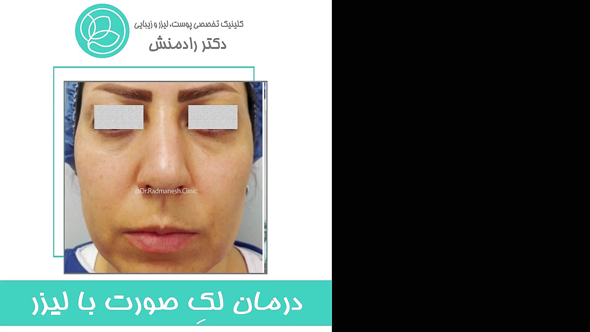 درمان لک صورت با لیزر جراحی گوش