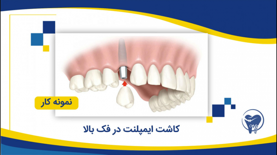 نمونه کار - کاشت ایمپلنت در فک بالا کلینیک دندانپزشکی دکتر عزیز گشاده رو