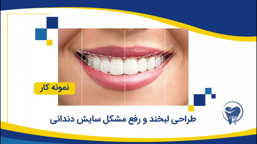 نمونه کار - طراحی لبخند کلینیک دندانپزشکی دکتر عزیز گشاده رو