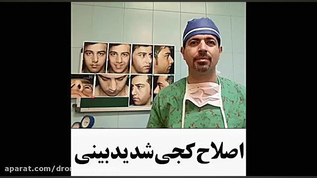 اصلاح کجی بینی توسط دکتر امید ابراهیمی دکتر امید ابراهیمی