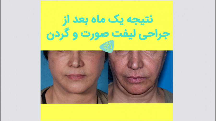 نتیجه یک ماه بعد از جراحی لیفت صورت و گردن | دکتر اکبر بیات Blood Gas