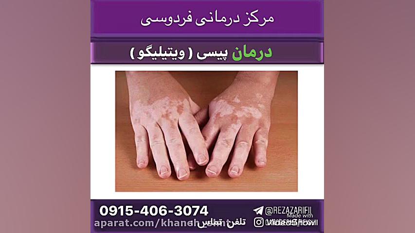 بهبود و درمان پیسی (ویتیلیگو) توئیتر