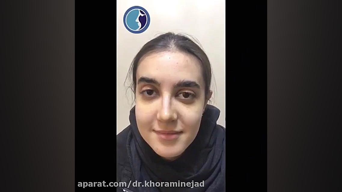 فیلم باور نکردنی قبل و بعد جراحی بینی استخوانی در دختر خانم جوان بیماری آمیلوئیدوز فامیلیال