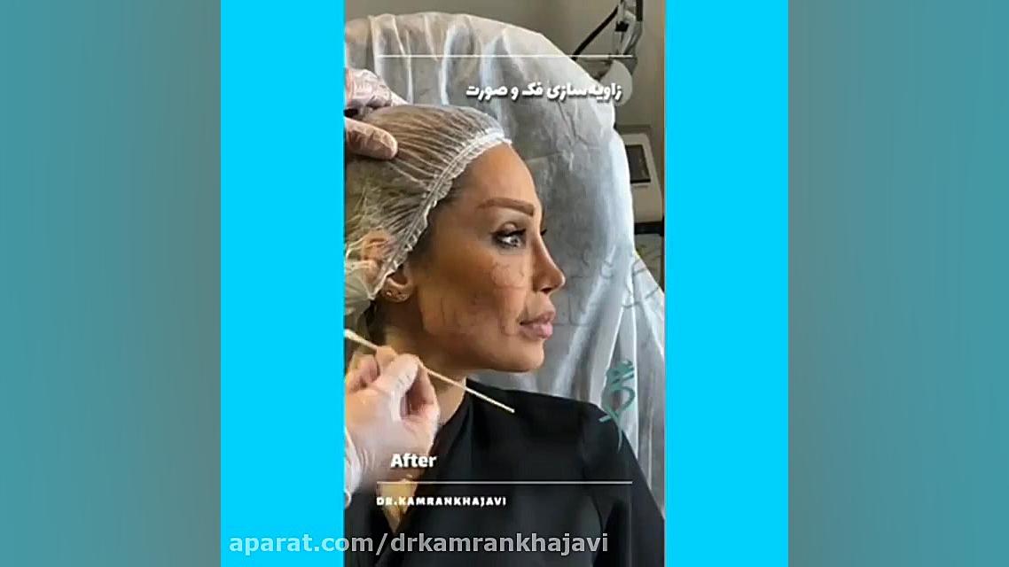 فیلم زاویه سازی فک و صورت درمان جای جوش
