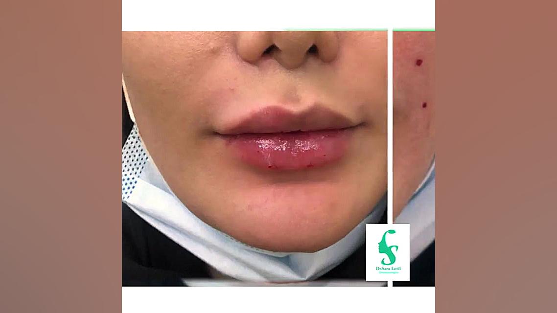 تغییر صد در صدی چهره با تزریق ژل و خط خنده دکتر سار ا لطفی