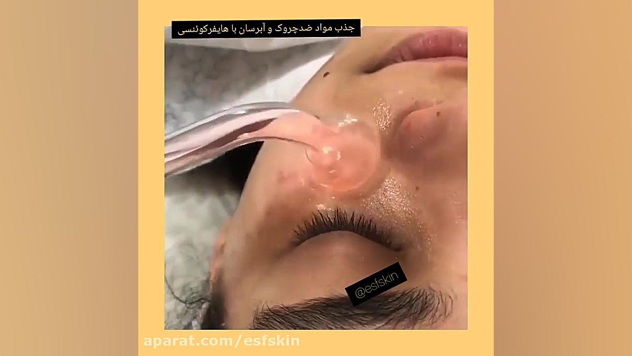 کلاژن سازی پوست لیزر صورت