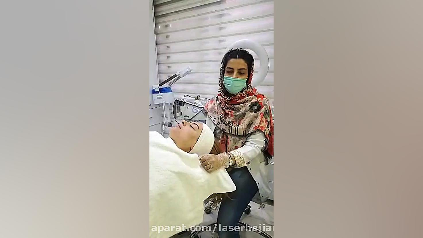 مزونیدلینگ زاویه سازی صورت