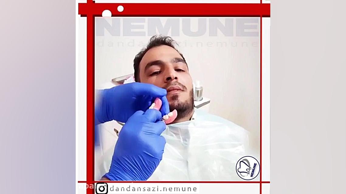 نما نما - دندانسازی نمونه - ساخت دندان مصنوعی در 48 ساعت فرمانزوماب