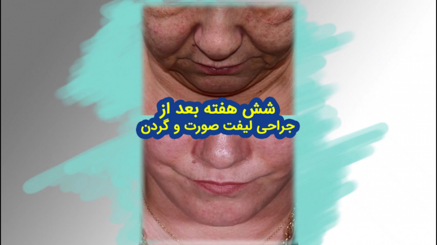 نتيجه شش هفته بعد از جراحی لیفت صورت و گردن | دکتر اکبر بیات کلینیک پوست
