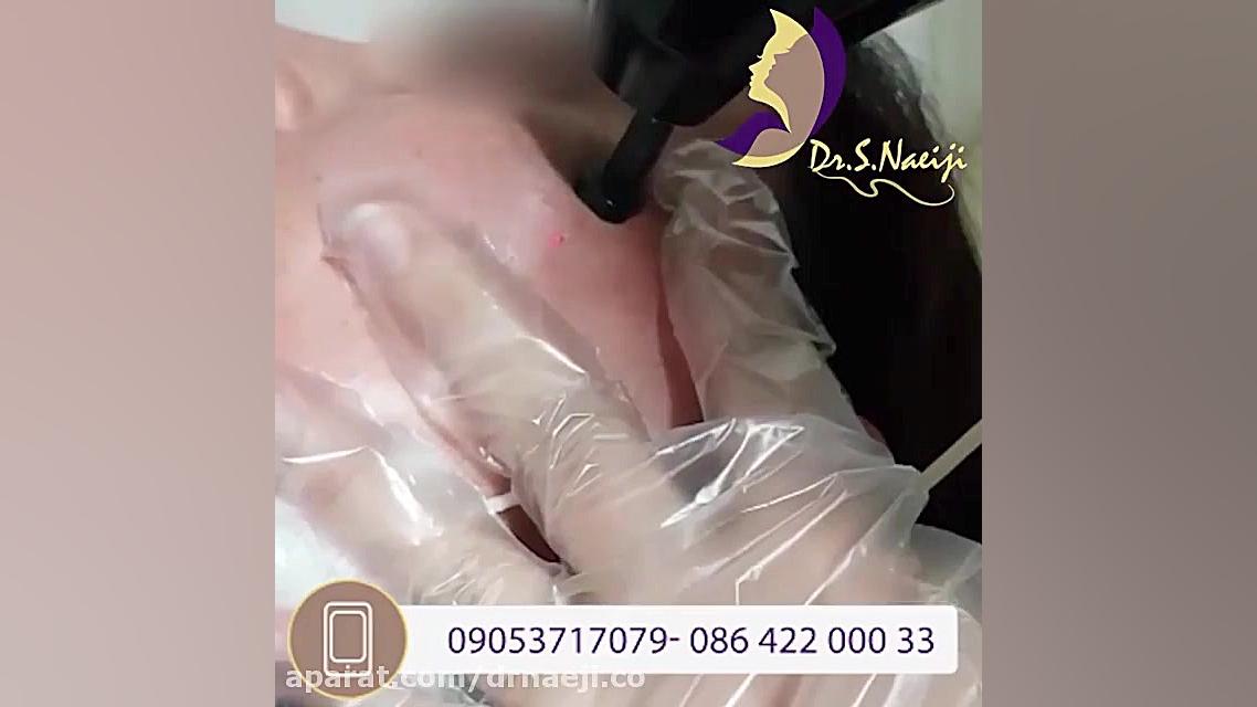 فیلمی باور نکردنی از برداشتن خال با لیزر CO2 دکتر صدیقه نائیجی | متخصص پوست و مو در قم