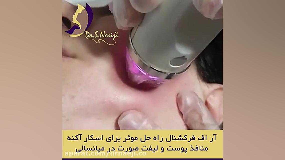 آر اف فرکشنال، یک راه حل موثر برای اسکار آکنه، منافذ پوست و لیفت صورت دکتر صدیقه نائیجی | متخصص پوست و مو در قم