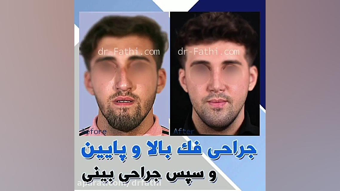 فیلم جراحی فک بالا و پایین به همراه جراحی بینی بیماری کاوازاکی