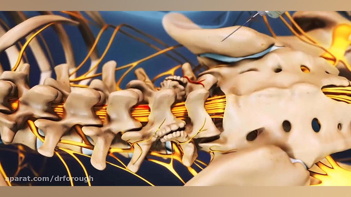 جراحی بسته دیسک کمر اصلاح طرح لبخند