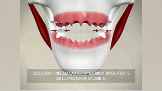 پوستریور دندان (posterior) دکتر سهیل سالاری
