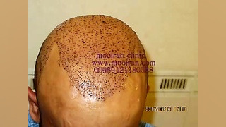 12 کاشت مو به روش fit نمای جلو و پشت سر هایپررفلکسی