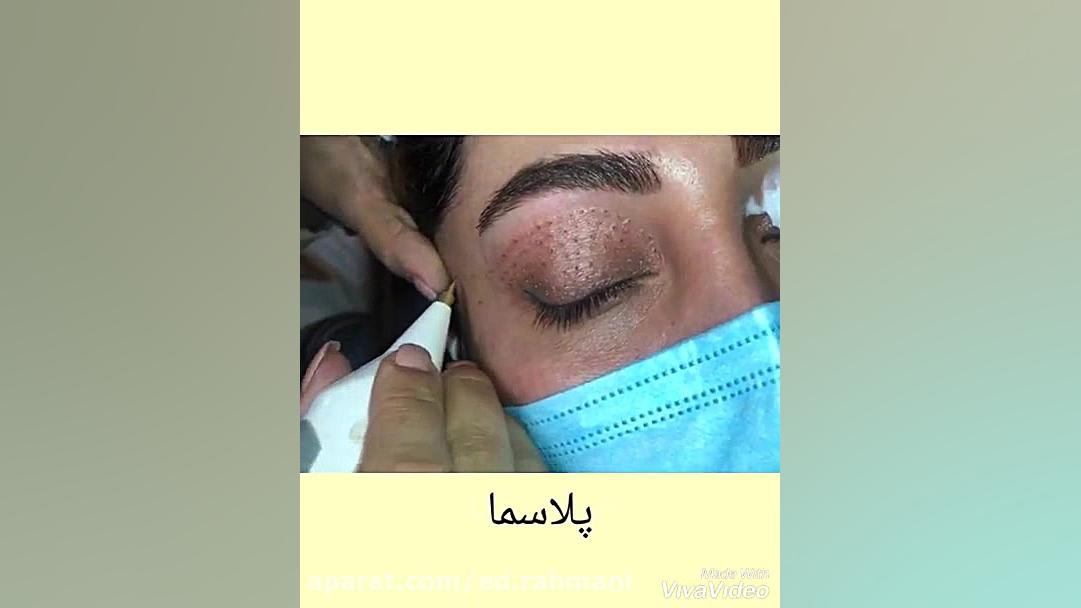 پلاسما پشت پلک ویروس‌شناسی پیشرفته