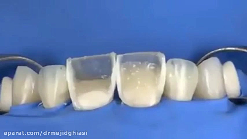 ترمیم شکستگی دندان دکترمجیدقیاسی