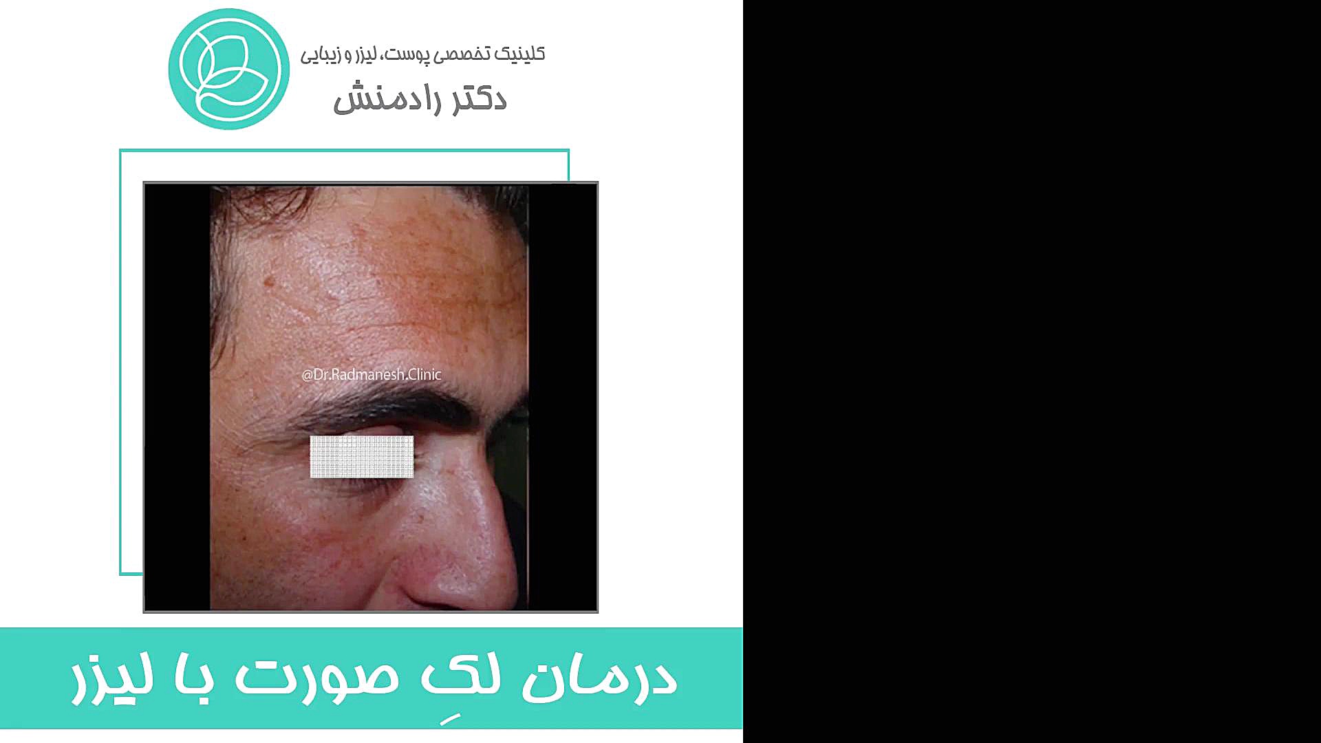 درمان لک صورت با لیزر دندانپزشک زیبایی