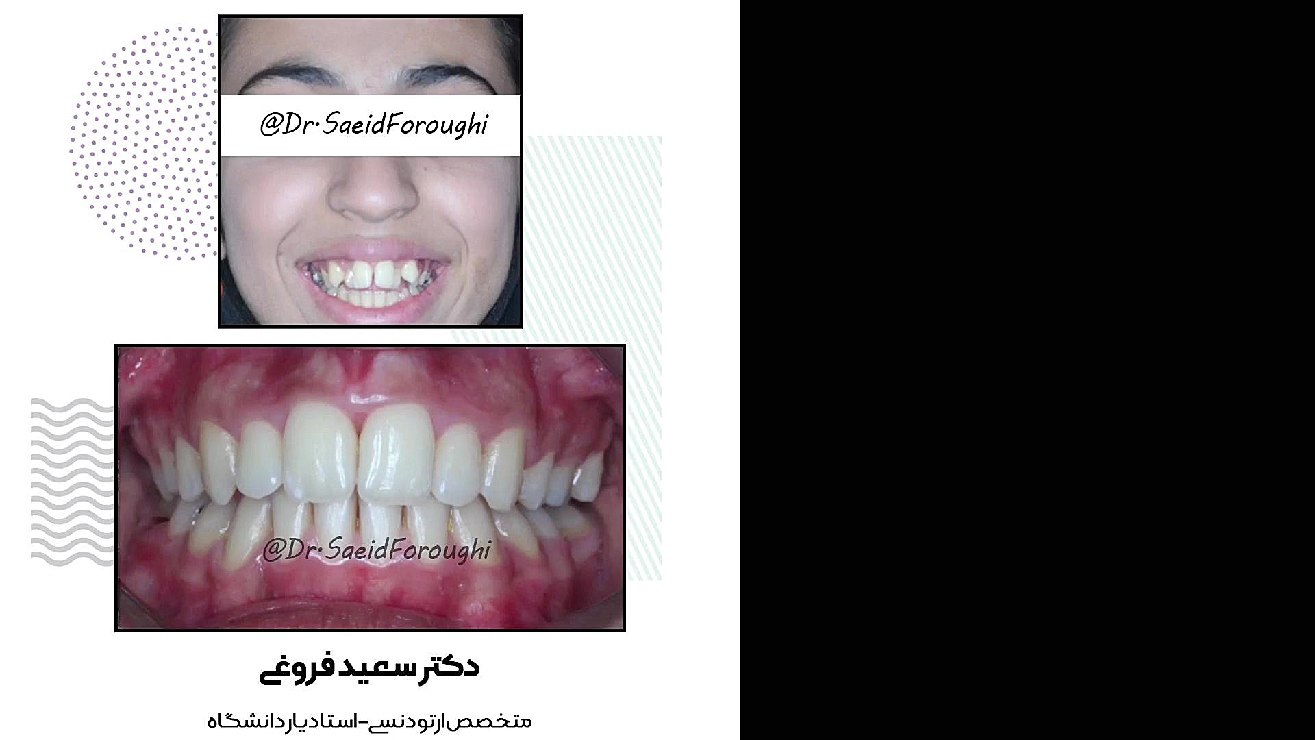 درمان با ارتودنسی ثابت دکتر سعید فروغی متخصص ارتودنسی
