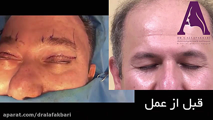 فیلم لیفت ابرو و پیشانی همزمان با بلفاروپلاستی بیماری فیبری دیسپلازی