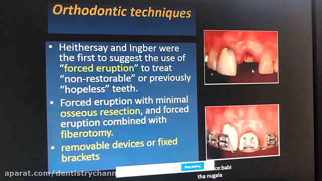 وبينار سمپوزيوم پريو بخش چهارم ( دکتر پزشک فر و دکتر دل آرام نيک و دکتر صادقي ) کلونیک اسپاسم
