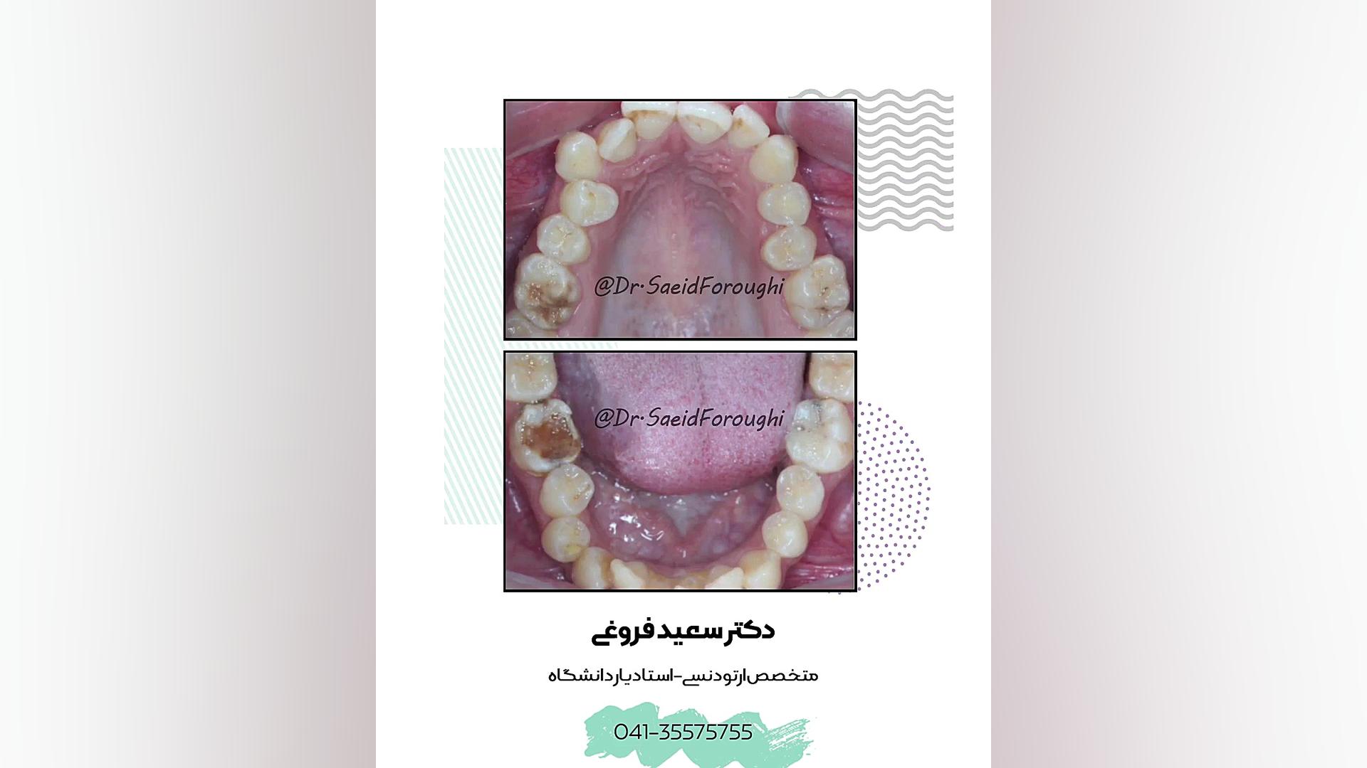 تصحیح ناقرینگی قوس دندانی و بی نظمی دندانها توسط ارتودنسی ثابت دکتر سعید فروغی متخصص ارتودنسی