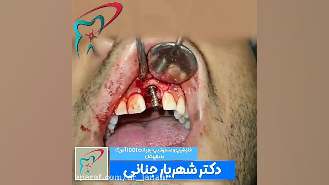 فیلم ایمپلنت دندان یک بالا ایربسارتان