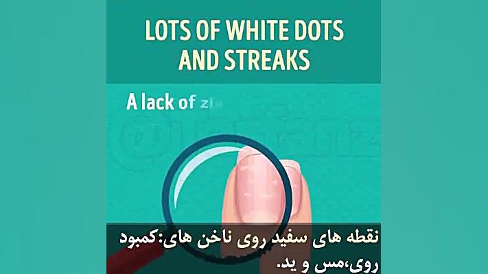 ناخن های شما چه بیماریهایی را ممکن است نشان دهند پریناز ایزدیار