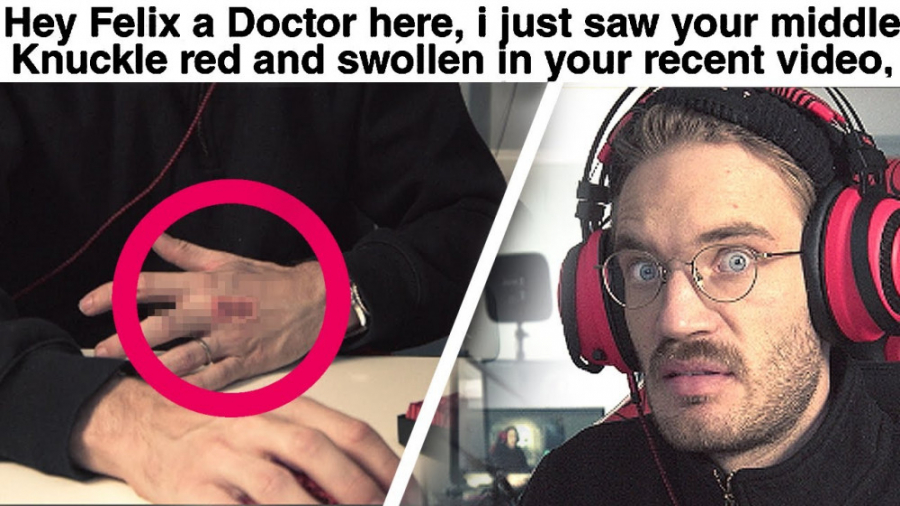 Doctor Reacts To my Injury ( serious ) // پیودی پای // pewdiepie